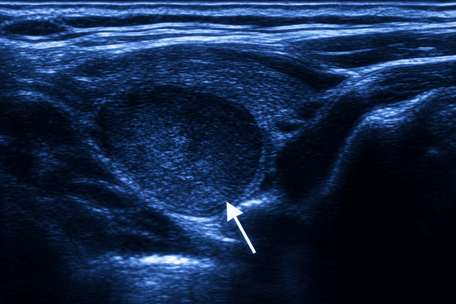 Malignancy Risk Prediction in Thyroid Nodules